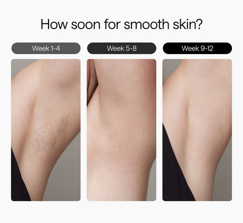 Ulike Laser Hair Removal
